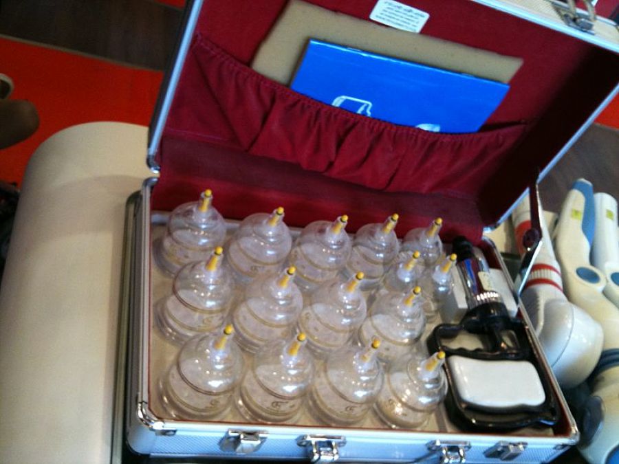 Información Rápida para Terapia con ventosas